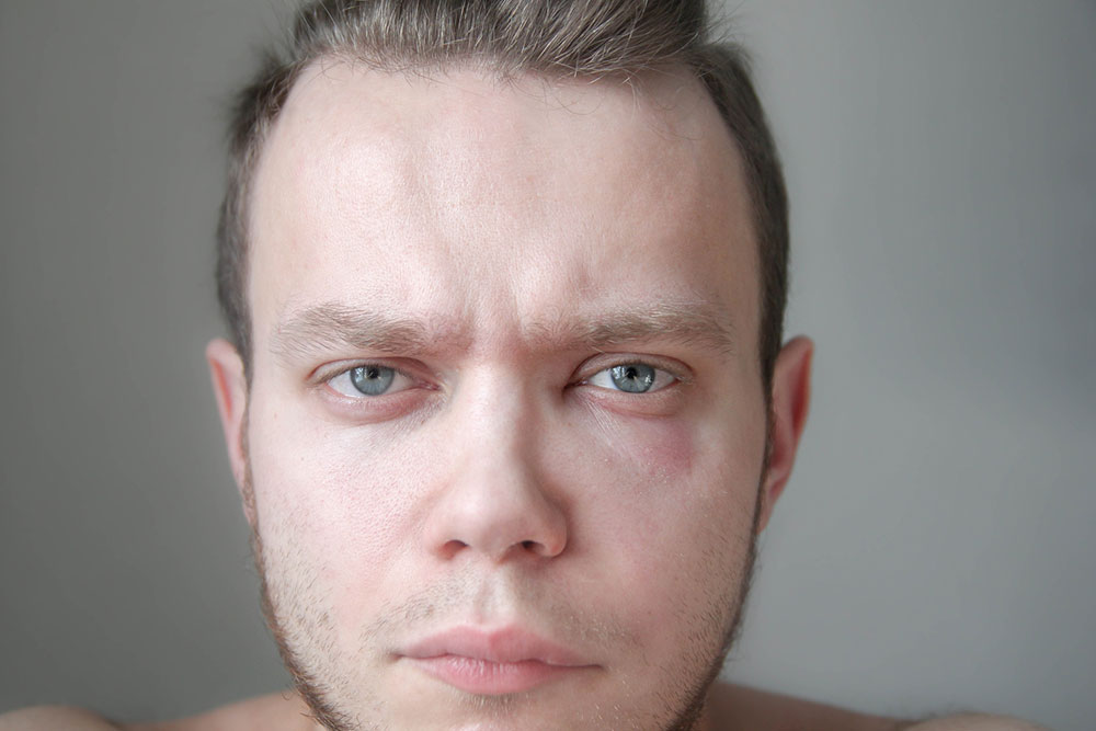 Food and Other Triggers for Hereditary Angioedema Attacks